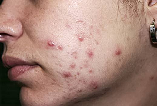 FDA aceita pedido da Vyome Biosciences para avaliar composto para tratar acne