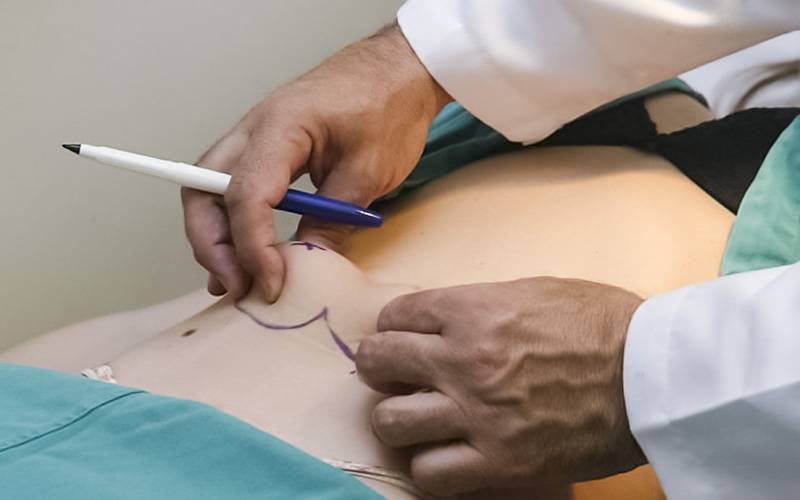 UPorto e Hospital São João realizam ensaios clínicos na área da abdominoplastia