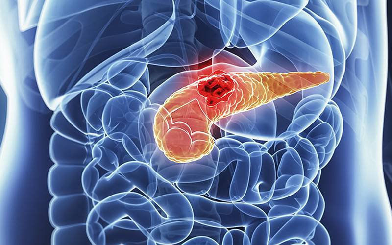 Pesquisa aponta para novo tratamento contra cancro do pâncreas