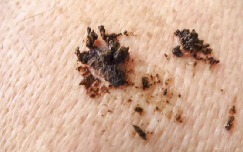 Remédios caseiros para tratar cancro da pele podem causar danos