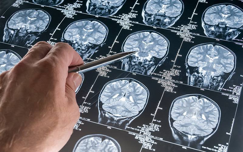 Cientistas ligam transtorno bipolar a região do cérebro inesperada