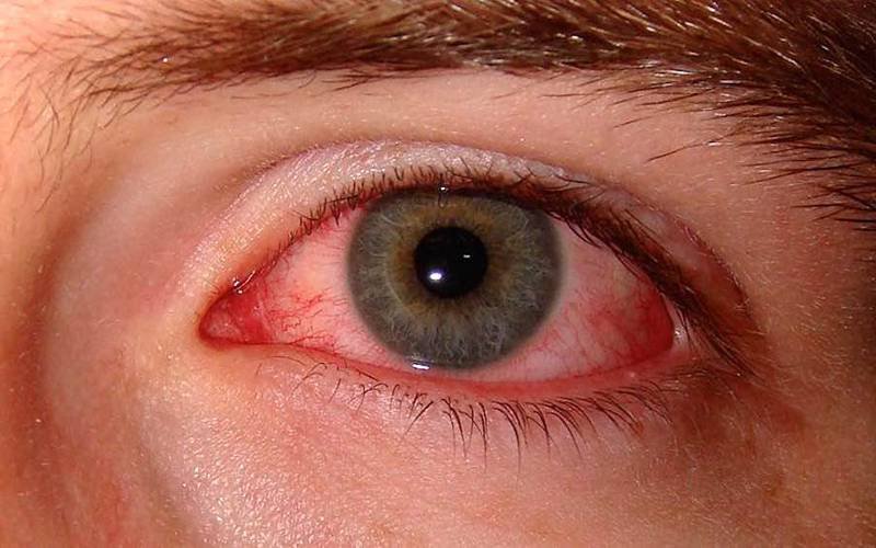 FDA aprova novo medicamento para doença do olho seco