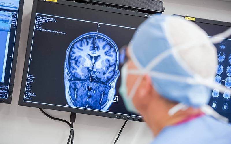 Nova técnica pode revolucionar tratamento cirúrgico da epilepsia