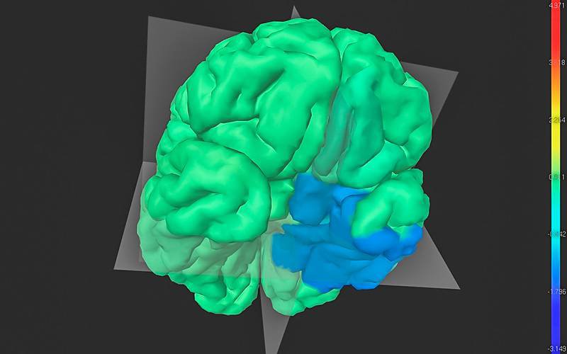 Cérebro virtual ajuda a perceber epilepsia