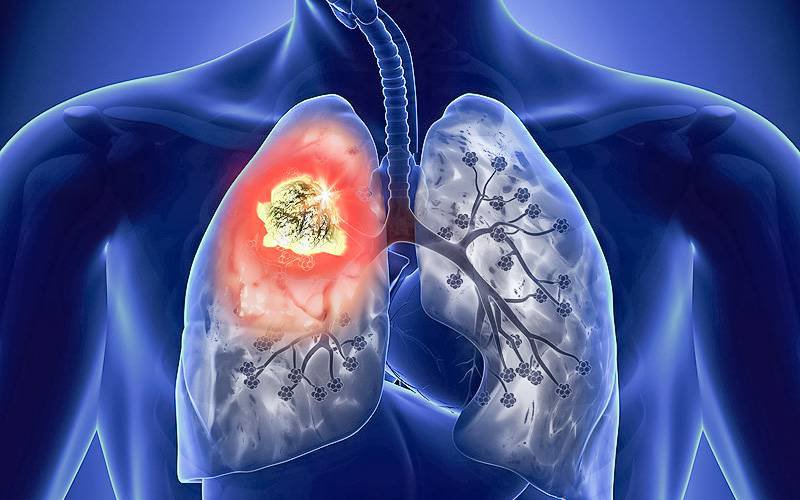 Computadores superam patologistas em distinguir tipo de cancro do pulmão