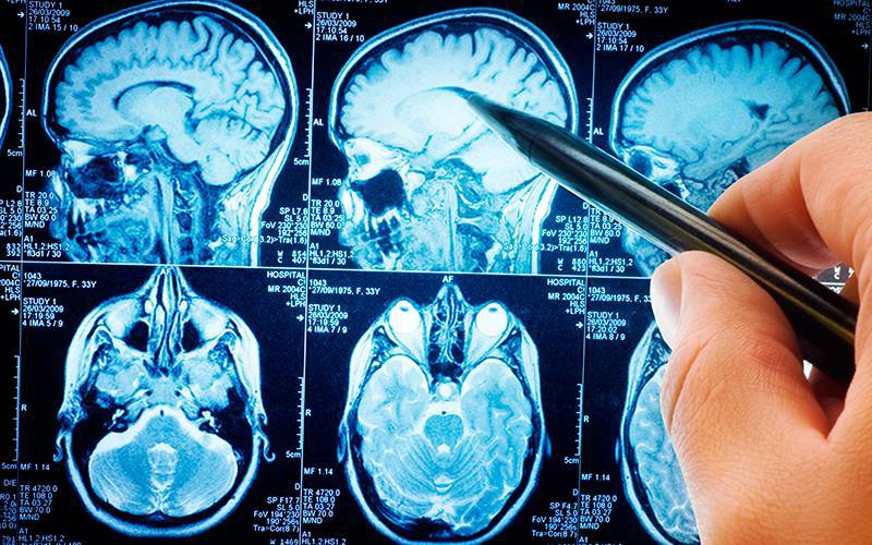 Doentes com biomarcadores associados ao Alzheimer podem ter supermemória