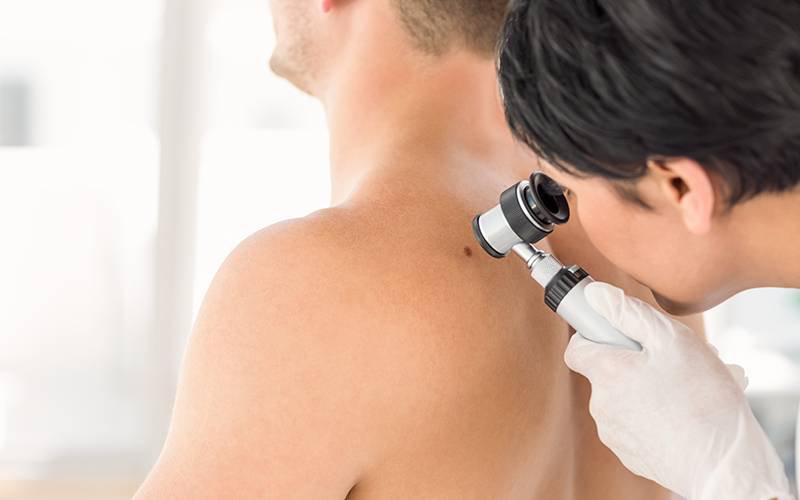 Roche avança com ensaios clínicos para tratamento de cancro da pele