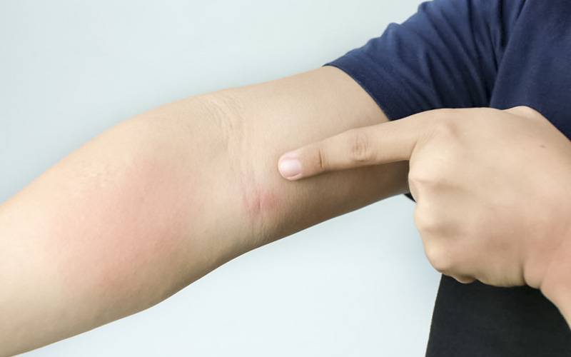 Dermatite Atópica é o tema da Semana Mundial da Alergia