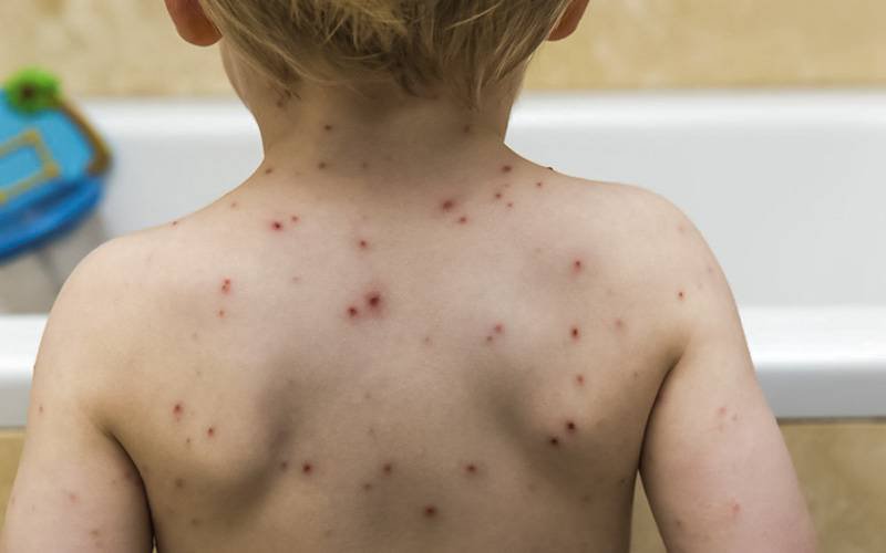Duas crianças diagnosticadas com sarampo não estavam vacinadas