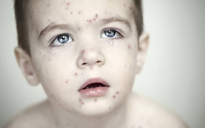 Registados mais de 13 400 casos de sarampo na Europa num ano