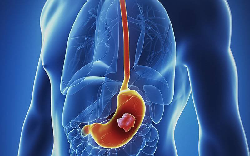 Cancro digestivo mata um português por hora