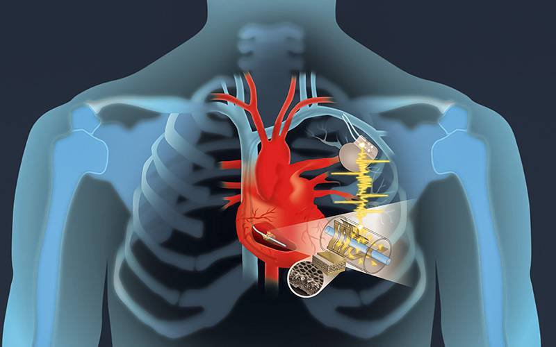 Pacemaker inovador usa eletricidade gerada pelo próprio coração