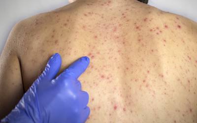 DGS declara fim de surtos de sarampo que infetaram quase 40 pessoas