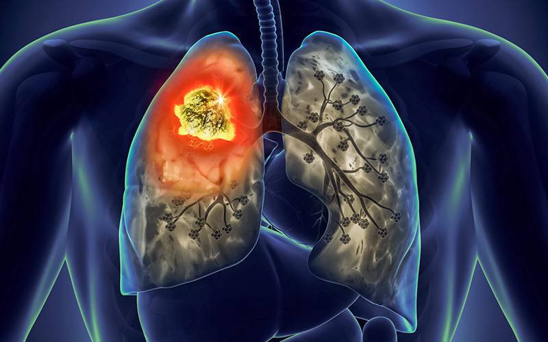 LPCC disponibiliza Linha Pulmão para informa sobre o cancro do pulmão