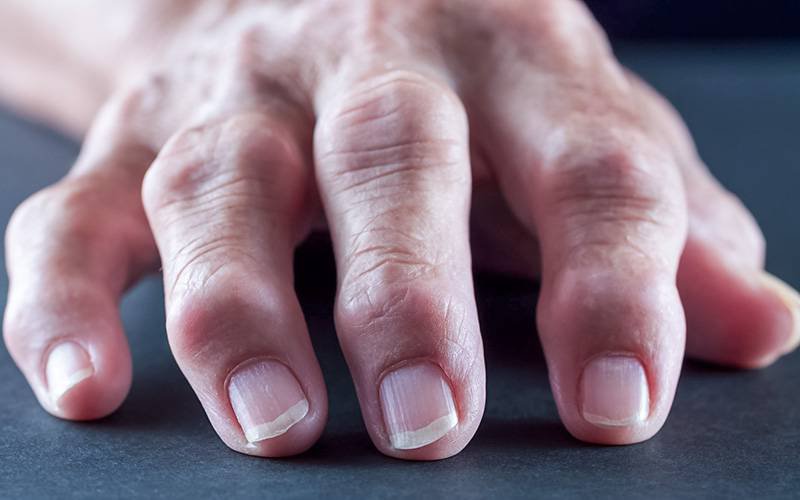 Sinais de artrite reumatoide podem aparecer muito antes do diagnóstico