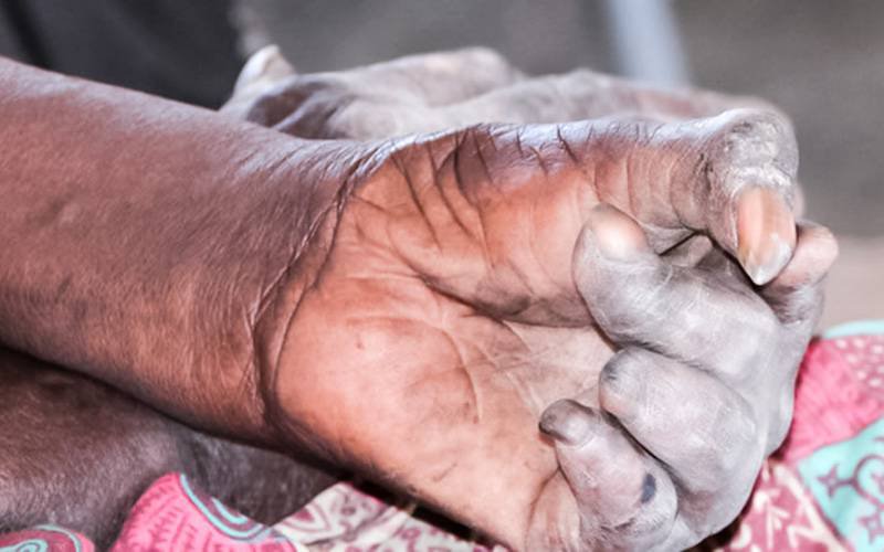 Brasil é o segundo país do mundo com mais casos de lepra