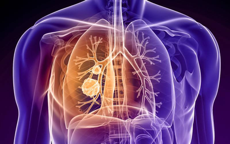 Pembrolizumab indicado no cancro do pulmão de pequenas células