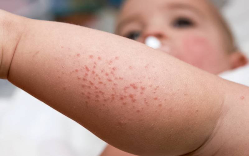 Eczema em idade pediátrica associado a outras alergias