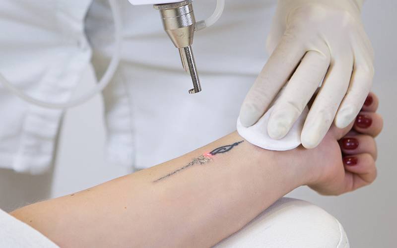 Tatuagem pode ser removida eficazmente com laser