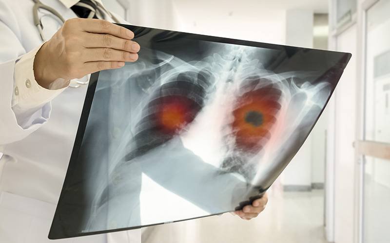 Cancro do pulmão é tumor que mais preocupa os portugueses