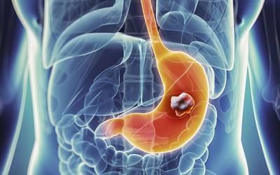 Diagnóstico precoce do cancro digestivo é fundamental para prognóstico