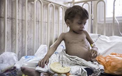 Uma em cada três crianças regista desnutrição ou sobrepeso