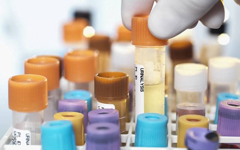 Teste inovador à urina deteta cancros da próstata