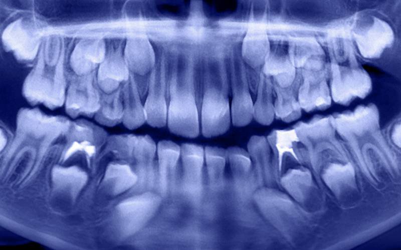 Radiografias dentárias podem detetar deficiência de vitamina D
