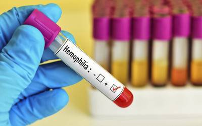 Terapia genética eficaz contra hemofilia A