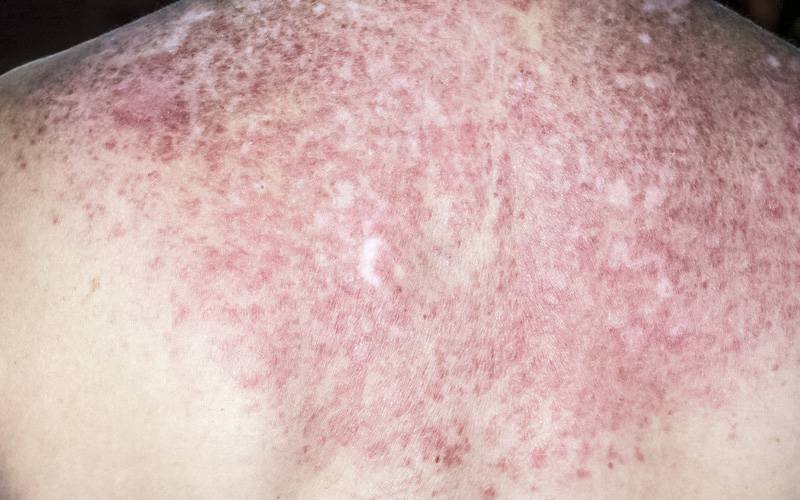 Lesões na pele de doentes com lúpus apresentam imensas bactérias
