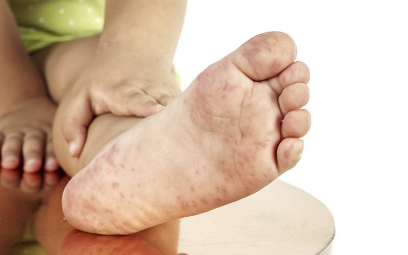 Covid-19: manchas nos pés podem ser sintoma em crianças e jovens