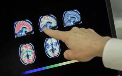 UC descobre possível novo alvo terapêutico contra Alzheimer