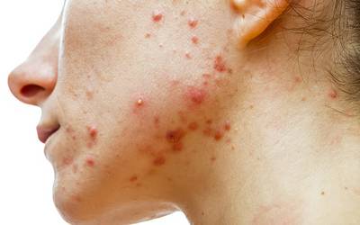 Probióticos podem ser benéficos no tratamento da acne