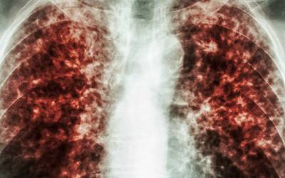 Descoberto novo alvo contra a tuberculose