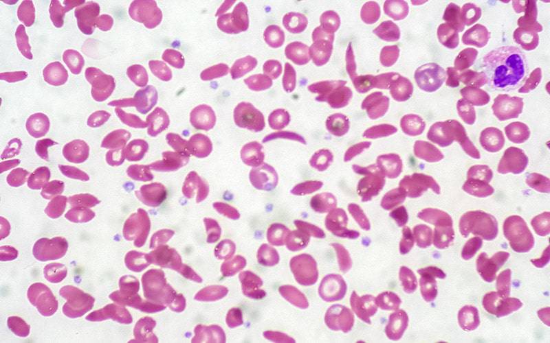 Descoberto tratamento mais eficaz para anemia falciforme
