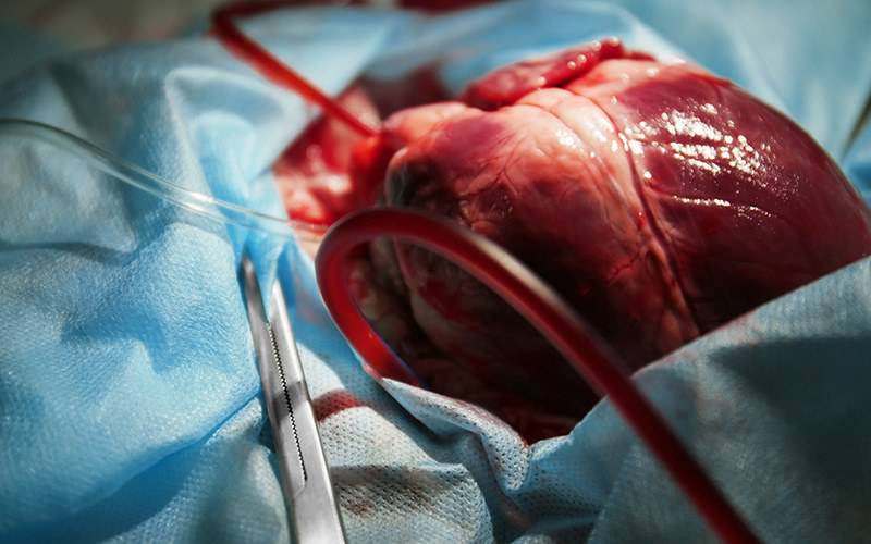 Transplantados cardíacos têm maior risco de morte por COVID-19