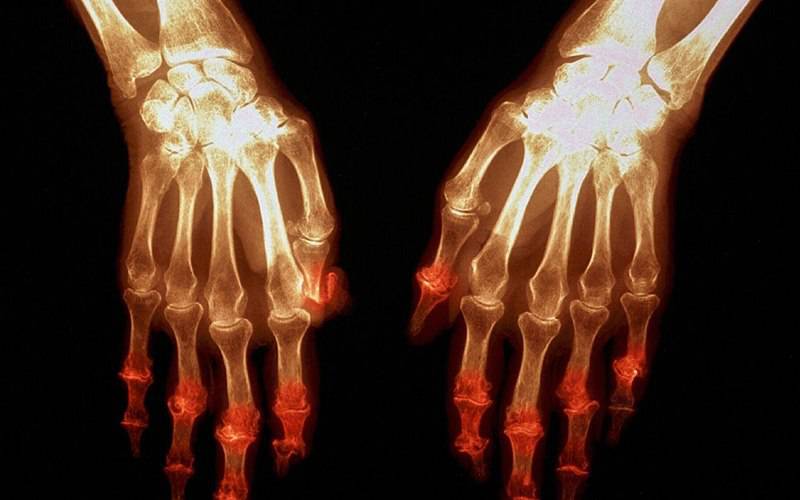 Um quarto dos casos de artrite está relacionado com excesso de peso