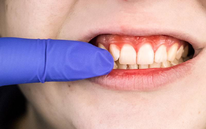 Progenitores transmitem para a prole bactérias da periodontite