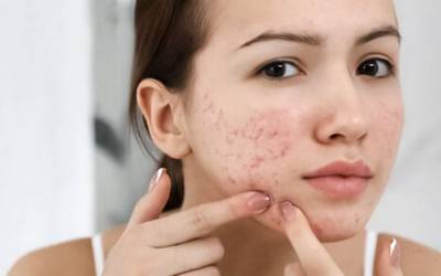 Lacticínios podem promover aparecimento de acne na idade adulta