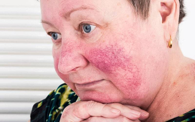 Máscara facial agrava sintomas de rosácea para maioria dos doentes