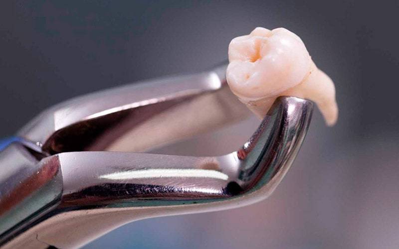 Extrair dentes do siso pode melhorar capacidade de degustação