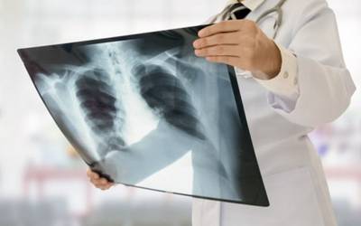 Cancro do pulmão: sintomas surgem nas fases avançadas