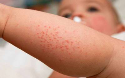 Campanha alerta para sintomas e impacto da dermatite atópica
