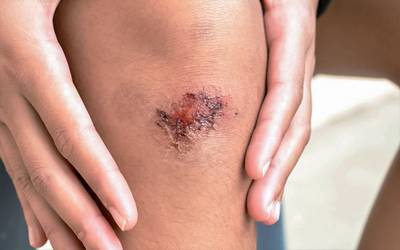 Descoberto mecanismo associado à cicatrização de lesões na pele