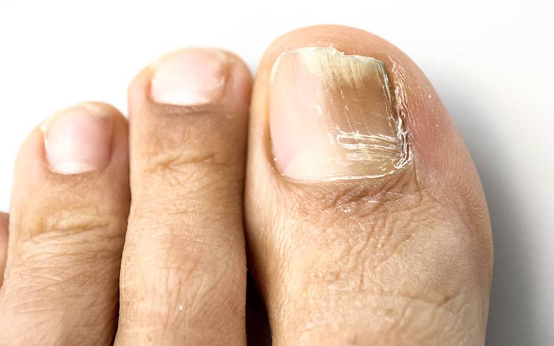 Alterações nas unhas dos pés podem indicar doença silenciosa