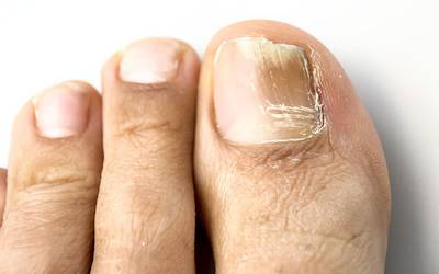 Alterações nas unhas dos pés podem indicar doença silenciosa