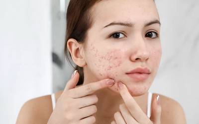 Estudo identifica mais 29 genes que elevam risco de acne