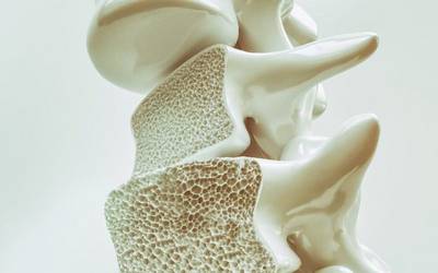 Níveis de hormona detetam perda óssea em mulheres