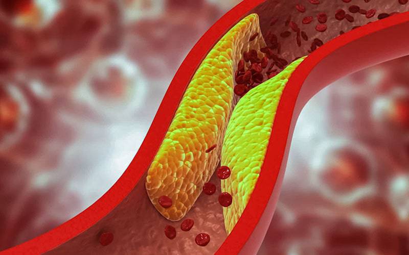 Colesterol: os sinais de alerta que podem levar a amputação
