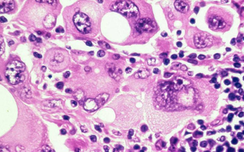 Melanoma: nova tecnologia de perfil genético revela biomarcadores